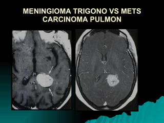 MENINGIOMA TRIGONO VS METS CARCINOMA PULMON