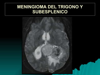 MENINGIOMA DEL TRIGONO Y SUBESPLENICO