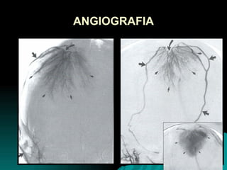 ANGIOGRAFIA