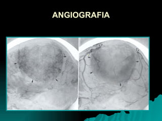 ANGIOGRAFIA