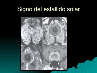 Signo del estallido solar