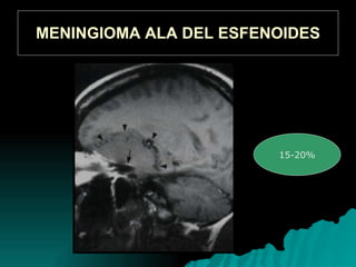 MENINGIOMA ALA DEL ESFENOIDES 15-20%