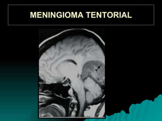 MENINGIOMA TENTORIAL