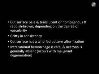 • Cut surface pale & translucent or homogenous &
reddish-brown, depending on the degree of
vascularity
• Gritty in consistency
• Cut surface has a whorled pattern after fixation
• Intratumoral hemorrhage is rare, & necrosis is
generally absent (occurs with malignant
degeneration)
 
