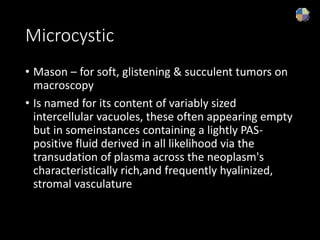 Microcystic
• Mason – for soft, glistening & succulent tumors on
macroscopy
• Is named for its content of variably sized
intercellular vacuoles, these often appearing empty
but in someinstances containing a lightly PAS-
positive fluid derived in all likelihood via the
transudation of plasma across the neoplasm's
characteristically rich,and frequently hyalinized,
stromal vasculature
 