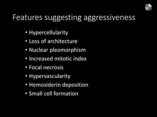 Features suggesting aggressiveness
• Hypercellularity
• Loss of architecture
• Nuclear pleomorphism
• Increased mitotic index
• Focal necrosis
• Hypervascularity
• Hemosiderin deposition
• Small cell formation
 