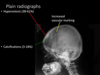 Plain radiographs
• Hyperostosis (38-61%)
• Calcifications (3-18%)
Increased
vascular marking
 