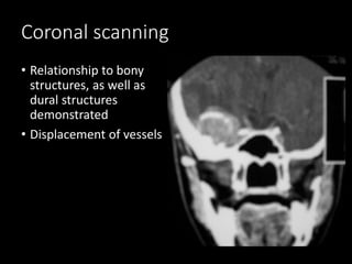 Coronal scanning
• Relationship to bony
structures, as well as
dural structures
demonstrated
• Displacement of vessels
 