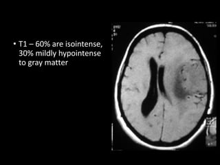 • T1 – 60% are isointense,
30% mildly hypointense
to gray matter
 