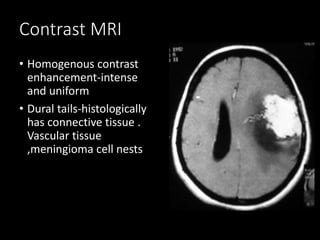 Contrast MRI
• Homogenous contrast
enhancement-intense
and uniform
• Dural tails-histologically
has connective tissue .
Vascular tissue
,meningioma cell nests
 