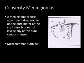 Convexity Meningiomas
• A meningioma whose
attachment does not lie
on the dura mater of the
skull base & does not
invade any of the dural
venous sinuses
• Most common subtype
 