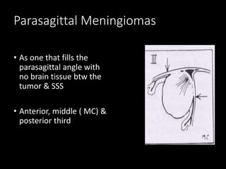 Parasagittal Meningiomas
• As one that fills the
parasagittal angle with
no brain tissue btw the
tumor & SSS
• Anterior, middle ( MC) &
posterior third
 