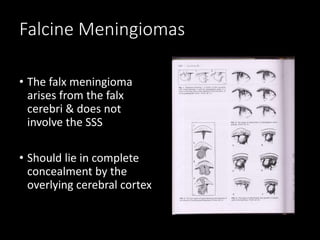Falcine Meningiomas
• The falx meningioma
arises from the falx
cerebri & does not
involve the SSS
• Should lie in complete
concealment by the
overlying cerebral cortex
 