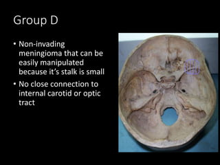 Group D
• Non-invading
meningioma that can be
easily manipulated
because it’s stalk is small
• No close connection to
internal carotid or optic
tract
 