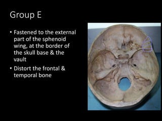 Group E
• Fastened to the external
part of the sphenoid
wing, at the border of
the skull base & the
vault
• Distort the frontal &
temporal bone
 