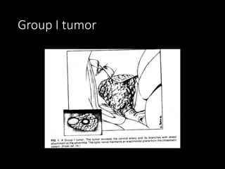 Group I tumor
 