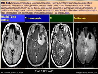 Dr. Peterson Xavier da Silva medpeterson@hotmail.com
ANATPATUNICAMP
 