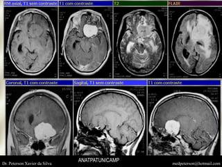 Dr. Peterson Xavier da Silva medpeterson@hotmail.com
ANATPATUNICAMP
 