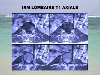 IRM LOMBAIRE T1 AXIALE 