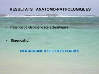 RESULTATS  ANATOMO-PATHOLOGIQUES  Présence de glycogène (caractéristique) Diagnostic :  MÉNINGIOME À CELLULES CLAIRES 