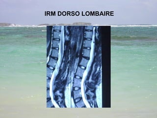 IRM DORSO LOMBAIRE 