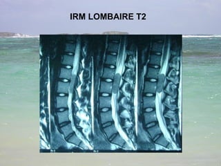 IRM LOMBAIRE T2 