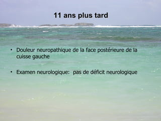 11 ans plus tard Douleur neuropathique de la face postérieure de la cuisse gauche Examen neurologique:  pas de déficit neurologique 