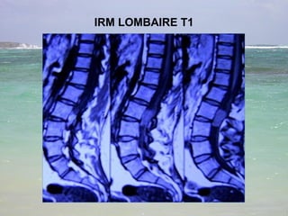 IRM LOMBAIRE T1 