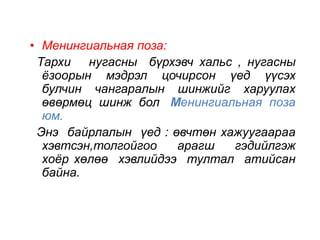 • Менингиальная поза: 
Тархи нугасны бүрхэвч хальс , нугасны 
ёзоорын мэдрэл цочирсон үед үүсэх 
булчин чангаралын шинжийг харуулах 
өвөрмөц шинж бол Менингиальная поза 
юм. 
Энэ байрлалын үед : өвчтөн хажуугаараа 
хэвтсэн,толгойгоо арагш гэдийлгэж 
хоёр хөлөө хэвлийдээ тултал атийсан 
байна. 
 