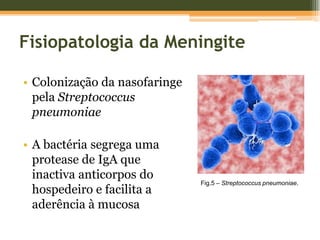 DiagnósticoMENINGITE PNEUMOCÓCICAProcesso inflamatório do espaço subaracnoideu e das meninges que revestem o SNC (leptomeninge)Fig.2 – Meninges num estado normal e numa situação de meningite.