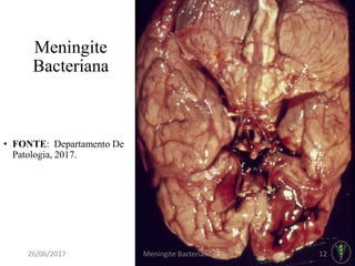 Meningite
Bacteriana
• FONTE: Departamento De
Patologia, 2017.
26/06/2017 Meningite Bacteriana 12
 