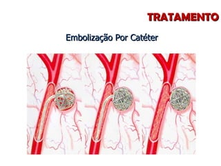TRATAMENTO Embolização Por Catéter 