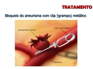 TRATAMENTO Bloqueio do aneurisma com clip (grampo) metálico 