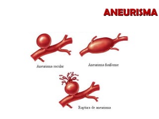 ANEURISMA 