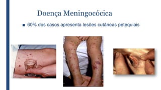 Doença Meningocócica
■ 60% dos casos apresenta lesões cutâneas petequiais
 