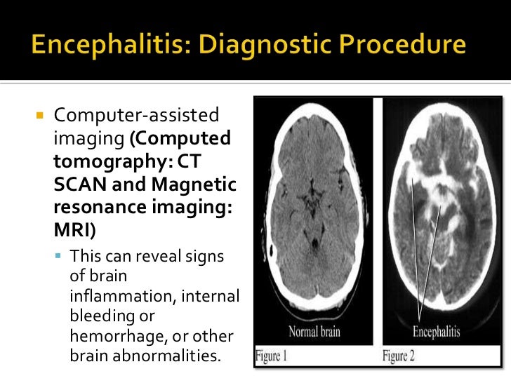 Meningitis and Encephalitis