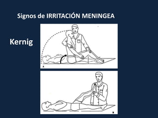 Signos de IRRITACIÓN MENINGEA
Kernig
