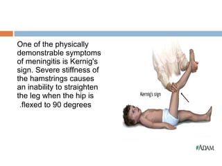 One of the physically
demonstrable symptoms
of meningitis is Kernig's
sign. Severe stiffness of
the hamstrings causes
an inability to straighten
the leg when the hip is
 .flexed to 90 degrees
 