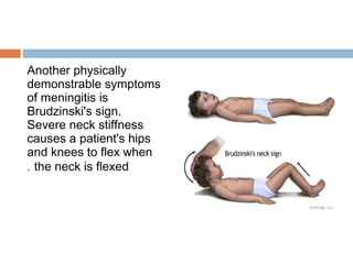 Another physically
demonstrable symptoms
of meningitis is
Brudzinski's sign.
Severe neck stiffness
causes a patient's hips
and knees to flex when
. the neck is flexed
 