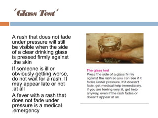 ’ Glass Test‘

A rash that does not fade
under pressure will still
be visible when the side
of a clear drinking glass
is pressed firmly against
.the skin
If someone is ill or
obviously getting worse,
do not wait for a rash. It
may appear late or not
.at all
A fever with a rash that
does not fade under
pressure is a medical
.emergency
 