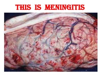 THIS IS MENINGITIS
 