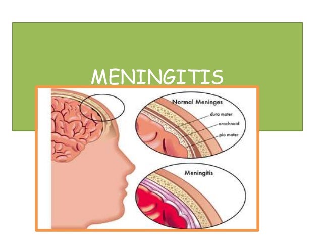 Resultado de imagen para meningitis