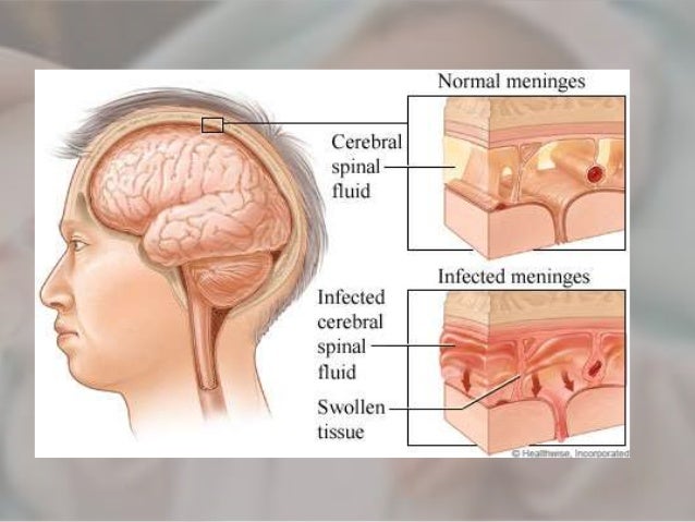 Meningitis in paediatrik