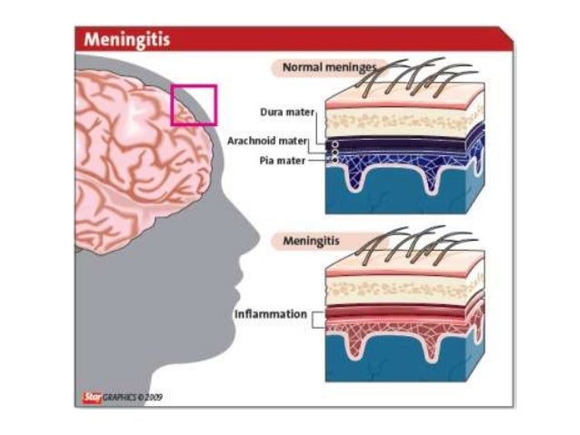 Meningitis