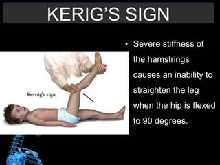 KERIG’S SIGN
• Severe stiffness of
the hamstrings
causes an inability to
straighten the leg
when the hip is flexed
to 90 degrees.
 