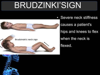 BRUDZINKI’SIGN
• Severe neck stiffness
causes a patient's
hips and knees to flex
when the neck is
flexed.
 