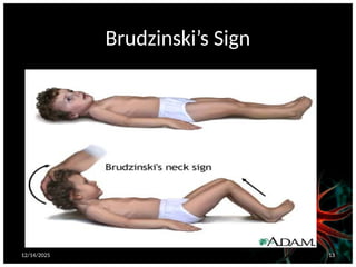 12/14/2025 13
Brudzinski’s Sign
 