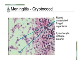 Meningitis