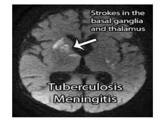 Meningitis