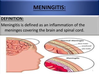 MENINGITIS:
DEFINITION:
Meningitis is defined as an inflammation of the
meninges covering the brain and spinal cord.
1
 
